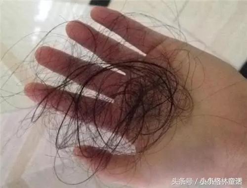 如何正确洗头三天不油防止脱发,头皮很痒头屑多脱发怎么回事