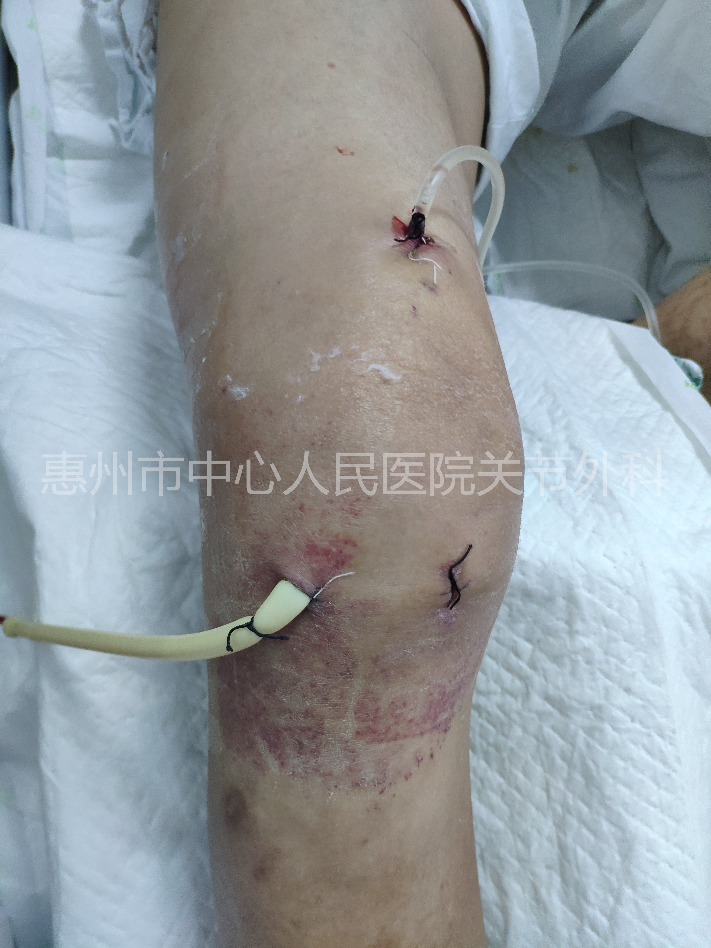 关节炎科普类短视频,化脓性关节炎怎么治疗最好最有效