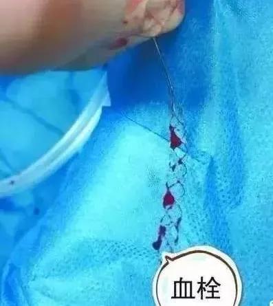 脚上暗藏化血栓开关,脚部静脉血栓的最快消除方法