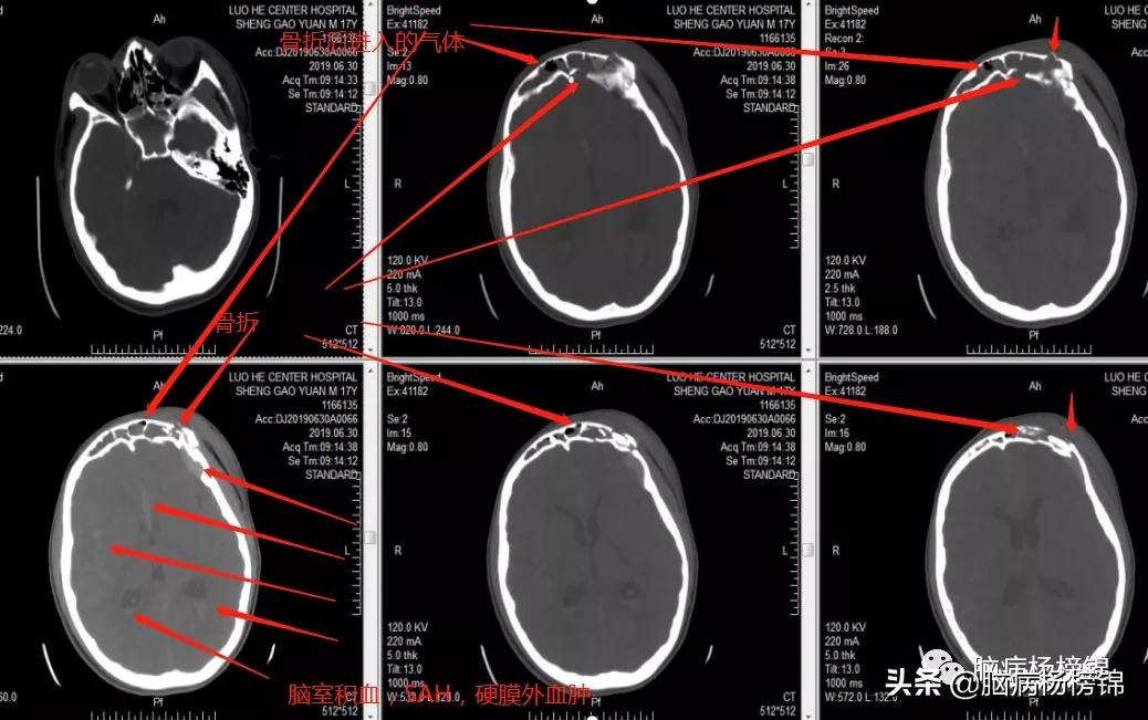 意外伤害很严重年纪轻轻难保命，谭院刀刀用真情豫南名医中中中