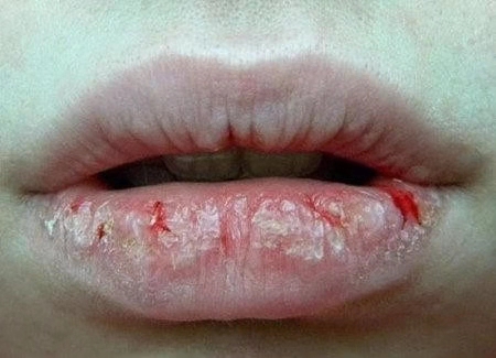 嘴巴干裂起皮推荐护唇油,秋冬季嘴唇干裂起皮这样涂