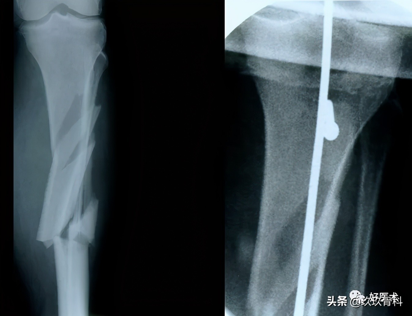 髓内钉技巧,髓内钉教学视频讲解