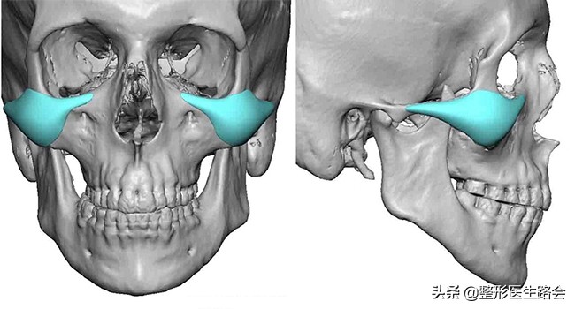 颧骨内推和填充玻尿酸哪个好,太阳穴凹陷颧骨突出填充还是内推