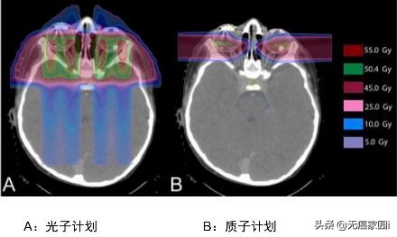 质子治疗手术适合大型肿瘤,肿瘤不能根治吗