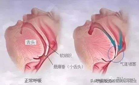宝宝口呼吸有什么危害,孩子口呼吸纠正最佳方法