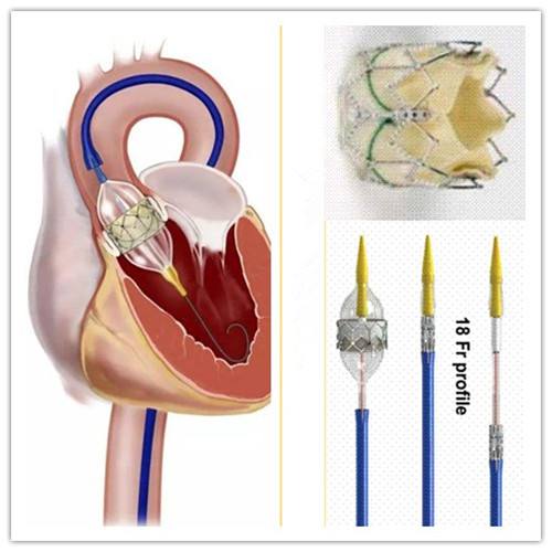 心脏病冠心病心血管疾病,冠心病心脏瓣膜病算是大病吗