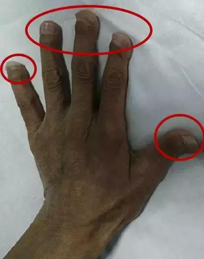 透析病人肌酐急速上升为什么,透析三次肌酐从1100降到500多