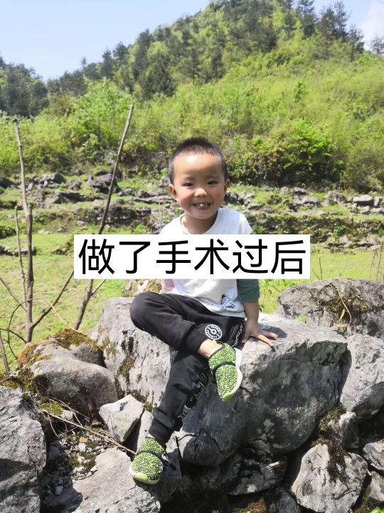 小耳畸形再造手术有后遗症吗,儿童小耳畸形去哪里做手术好