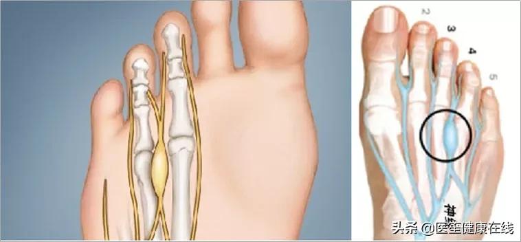 走路时脚的外面会一阵一阵的疼,走路时膝盖处突然刺痛是怎么回事