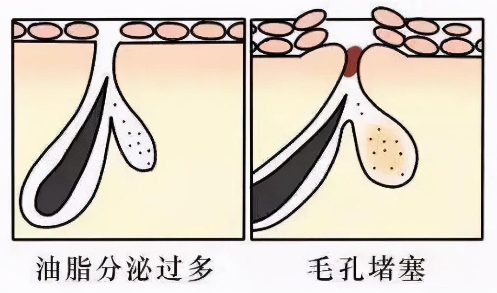 黑头粉刺毛孔粗大怎么隐形毛孔,毛孔粗大cc霜怎么用才能隐形毛孔