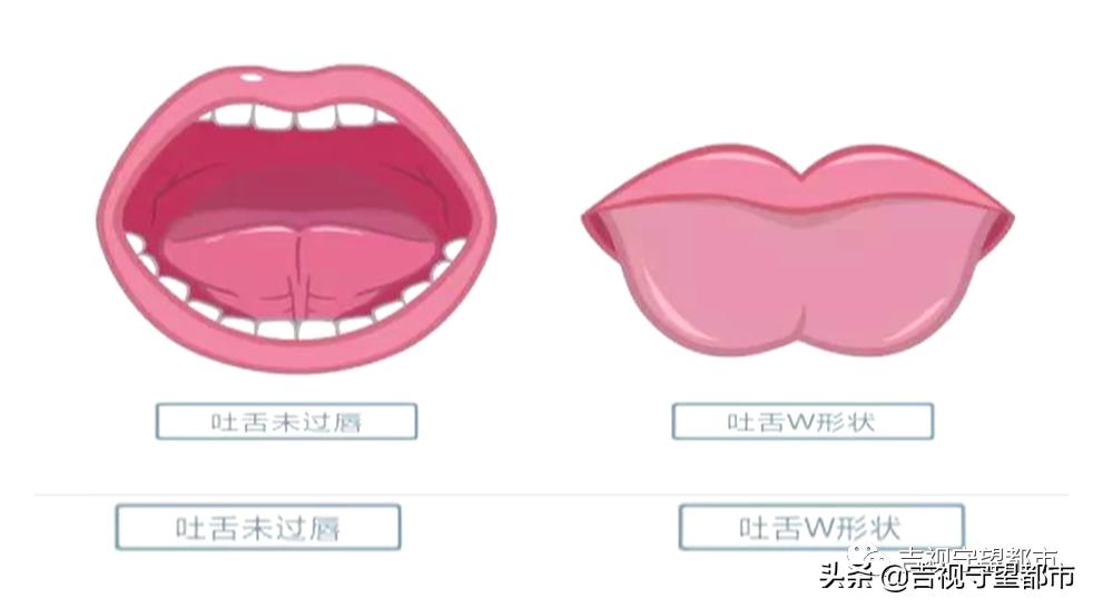 孩子说话有点大舌头要矫正吗,孩子讲话有点大舌头应该看什么科