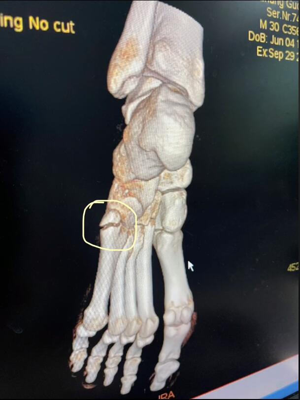 张国伟疲劳性骨折,张国伟跖骨骨折多久