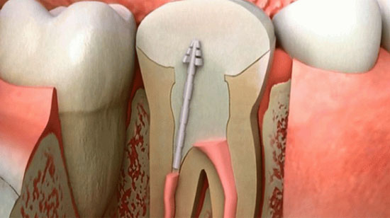根管治疗后可以只打桩不做冠吗,根管治疗加烤瓷冠修复能用多少年