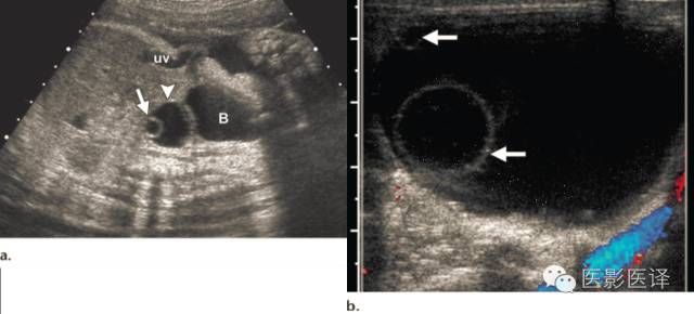 孕早期卵巢囊肿边界清形态规则,孕期卵巢囊肿呈液性伴点状回声