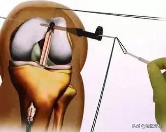 怎么判断交叉韧带损伤,膝关节交叉韧带损伤专家