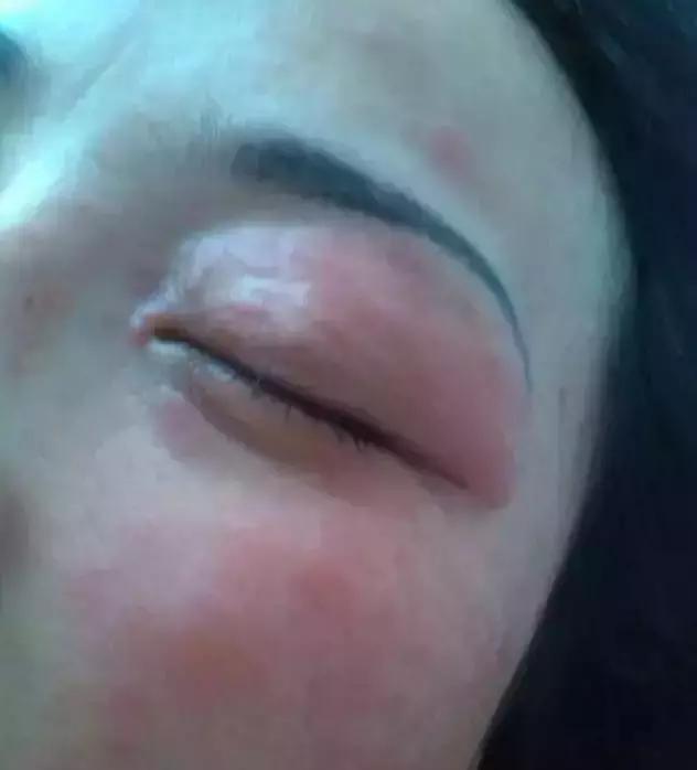 过敏的化妆品怎样处理,过敏性皮炎化妆品过敏怎么办