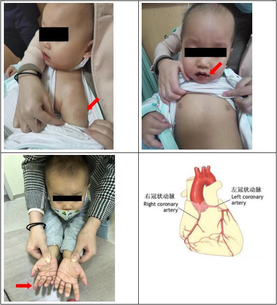 苏州市儿童医院川崎病专家,儿科救治新冠