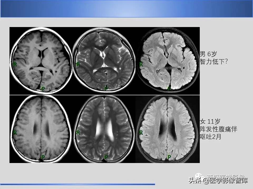 vr间隙概念,vr间隙需要做什么检查