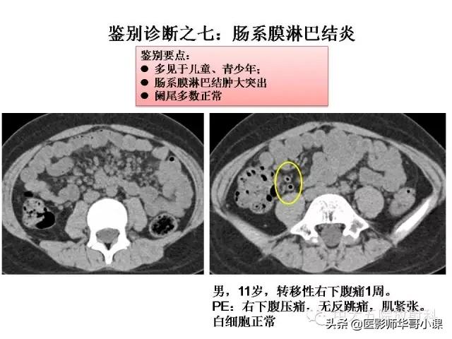 阑尾炎课件,阑尾炎的超声课件