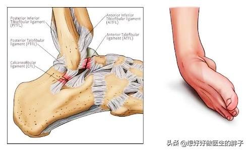 踝关节扭伤注意事项有哪些,踝关节轻微扭伤也会再次扭伤吗