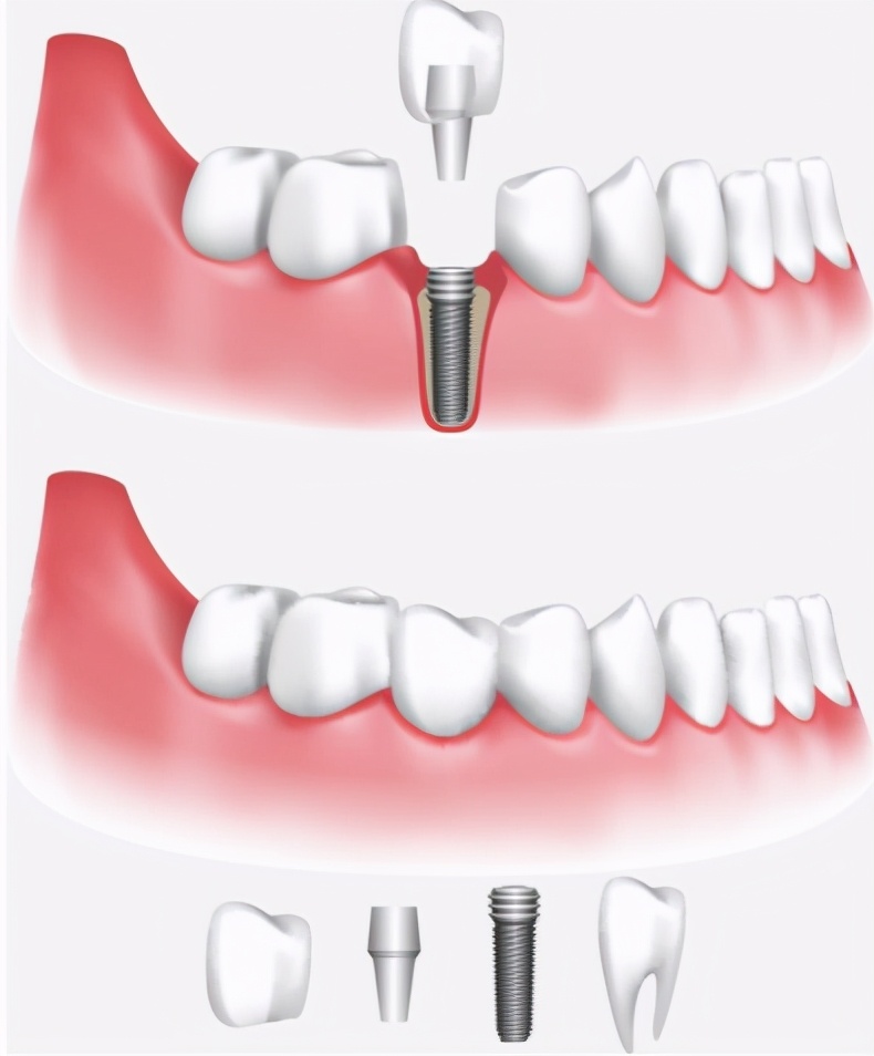 牙齿掉了不补牙可以吗,牙齿掉了不去管它有什么伤害吗