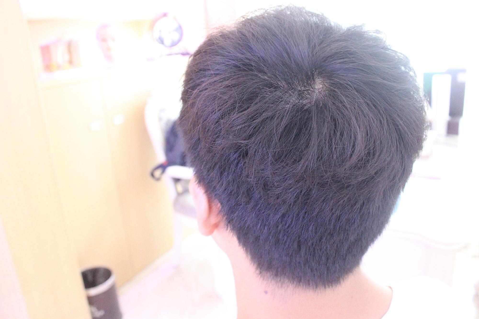 植发能和正常生长的头发一样长吗,植发靠谱吗