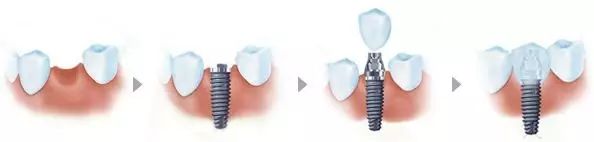 缺牙补牙疼不疼,缺牙补牙多少钱一颗