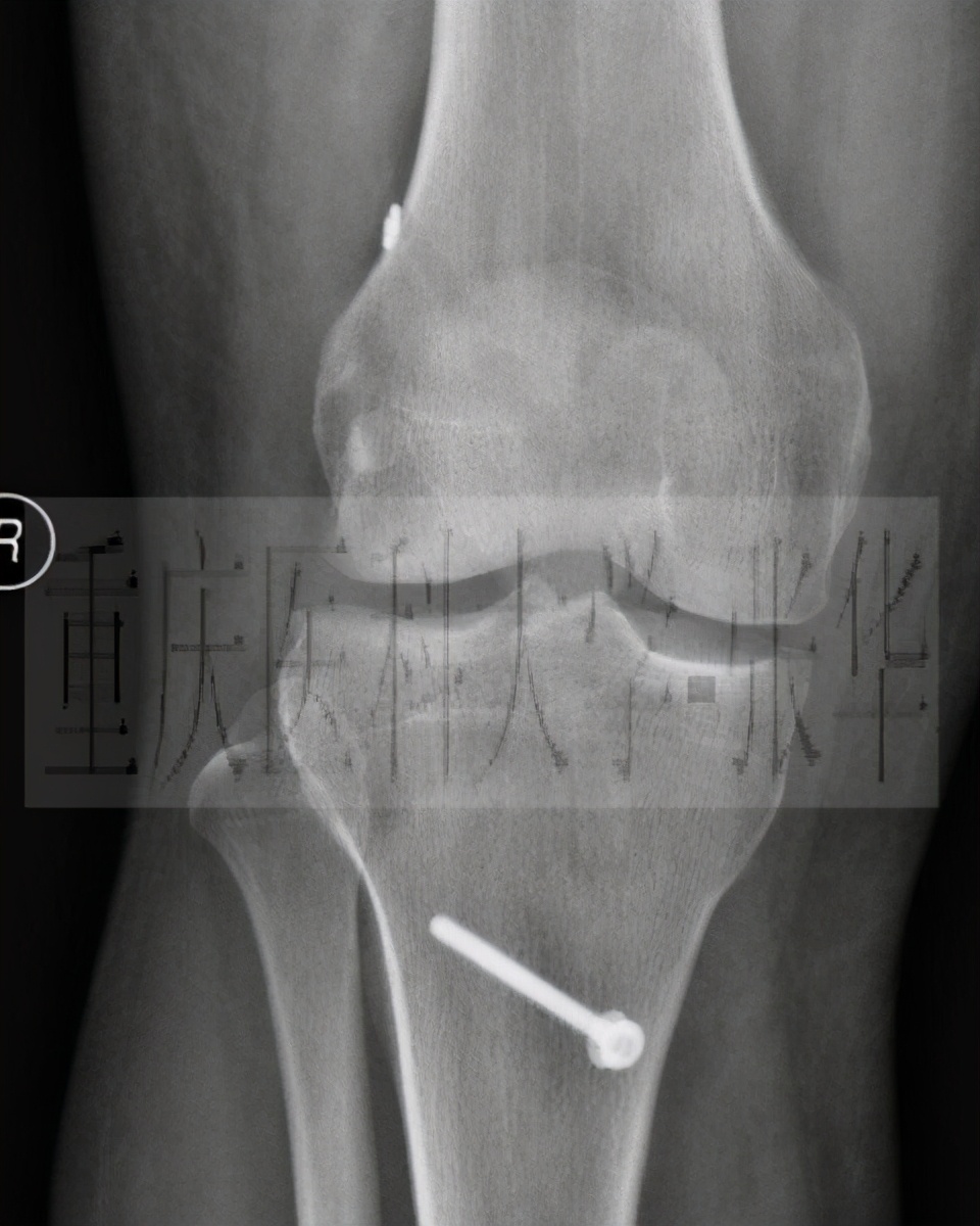 前交叉韧带损伤核磁共振,前后交叉韧带损伤的治疗