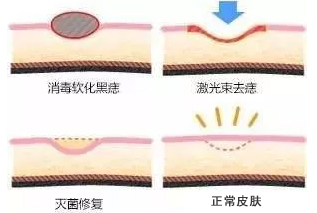 医生点痣,市人民医院能点痣吗