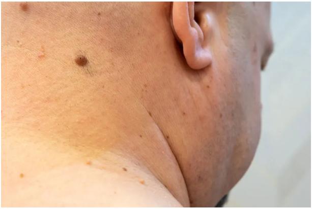 医生提醒这3种痣可能与癌症有关,长在哪些地方的痣都要切