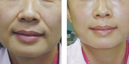 脸上有法令纹去除最好的方法,一般情况最早多大年龄出现法令纹