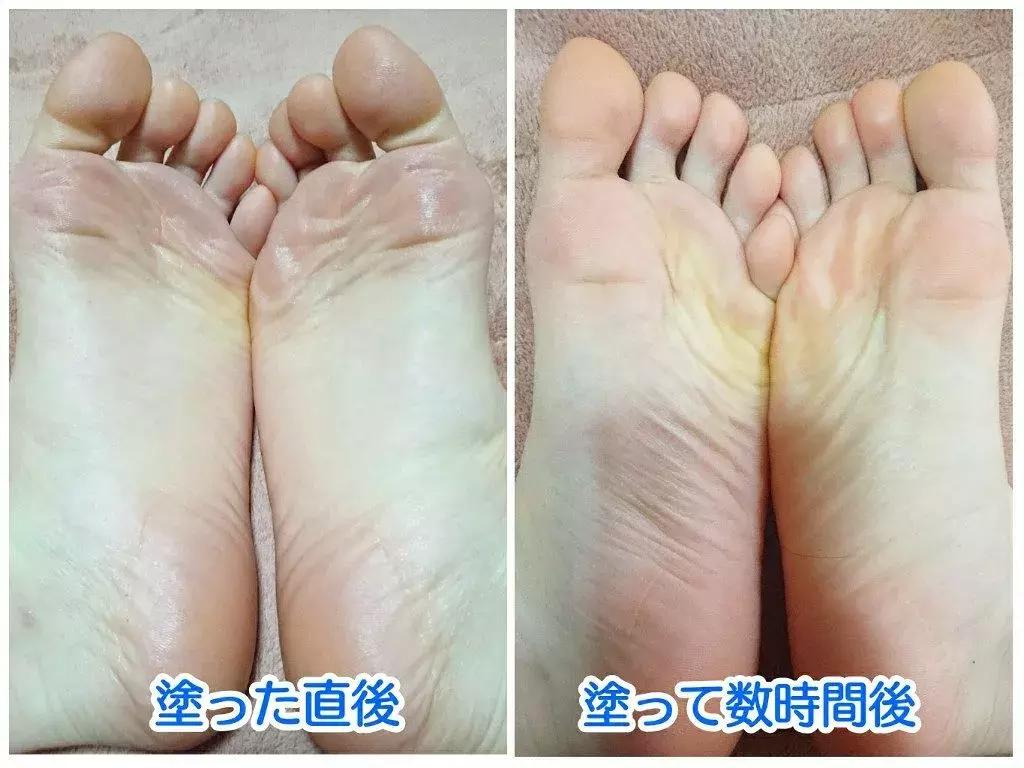 足部护理滋润皮肤让足部保持舒适,秋冬季足部护理