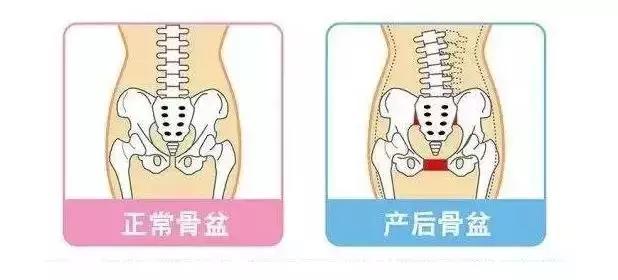 产后骨盆修复最佳时间段,产后骨盆修复的十大好处