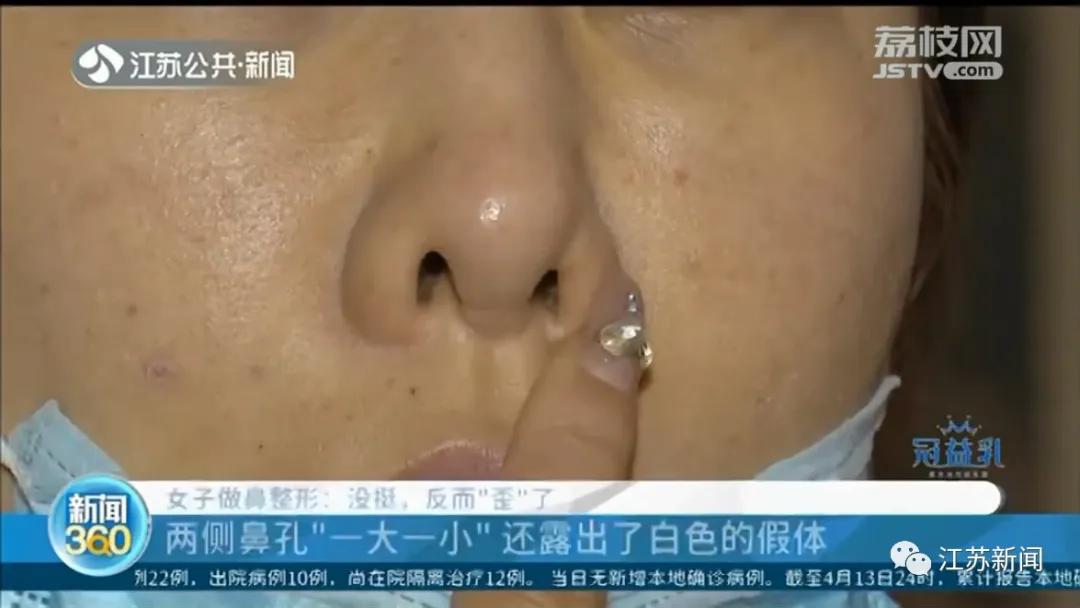 整容鼻子为什么歪了,整容鼻头歪了如何修复