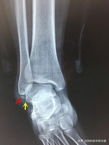 脚踝骨折做手术大概多少钱,右脚踝骨折做手术要多少小时