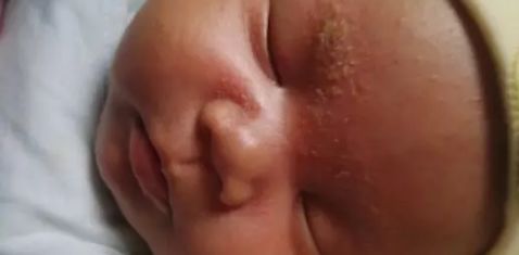 普及!宝宝湿疹不敢用药怕激素?湿疹护理指南来帮你