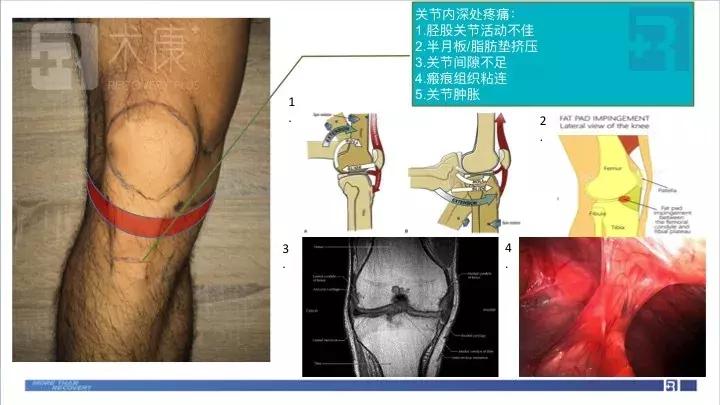 前叉术后两个月伤口处伸直会疼,前叉术后第11天的状态