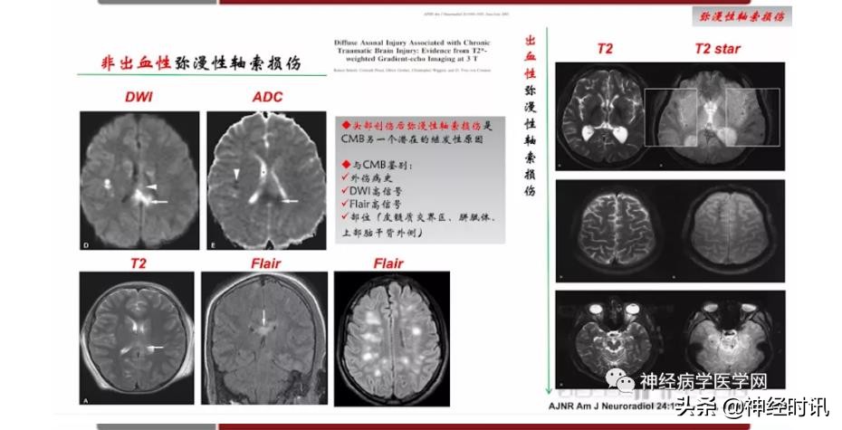 缺血性脑血管病出血评估,脑血管微出血怎么治疗