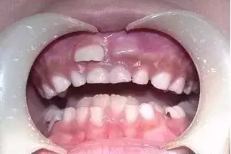 双层牙如何矫正位置,面对金口难开的家长该怎么沟通