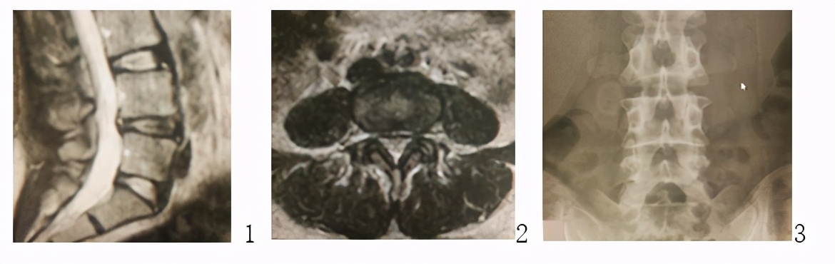 腰椎间盘射频治疗视频,世界医疗新技术