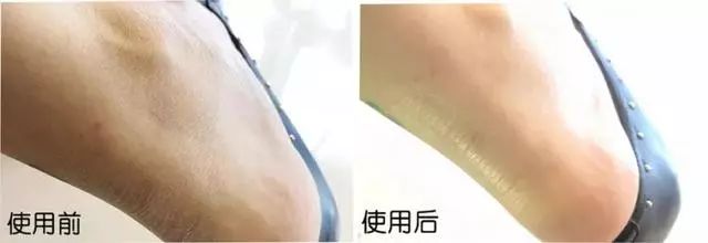 手脚干裂皮肤又厚又痒怎么办,冬天手脚干裂起皮怎么治疗