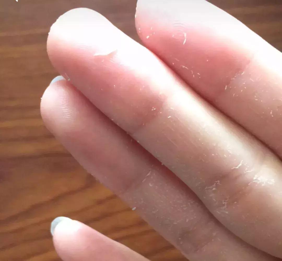 爱出油的皮肤怎么办,皮肤有痘出油用啥粉底