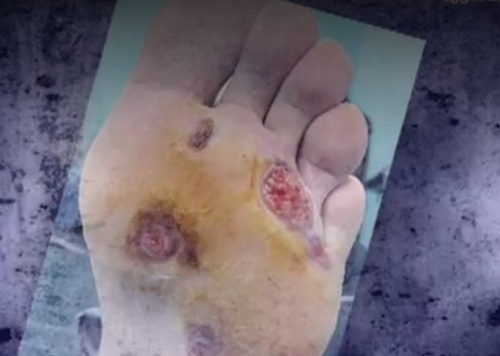 紧急！全澳多地出现“吃人菌”，感染后如同丧尸！24小时可吃一人