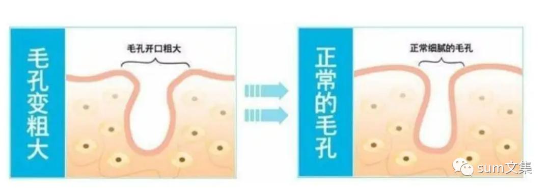 怎么改善毛孔粗大的敏感肌,改善毛孔粗大最有效的办法测评