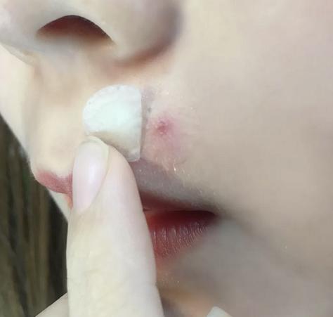 片仔癀净痘修护贴,抗痘贴片仔癀