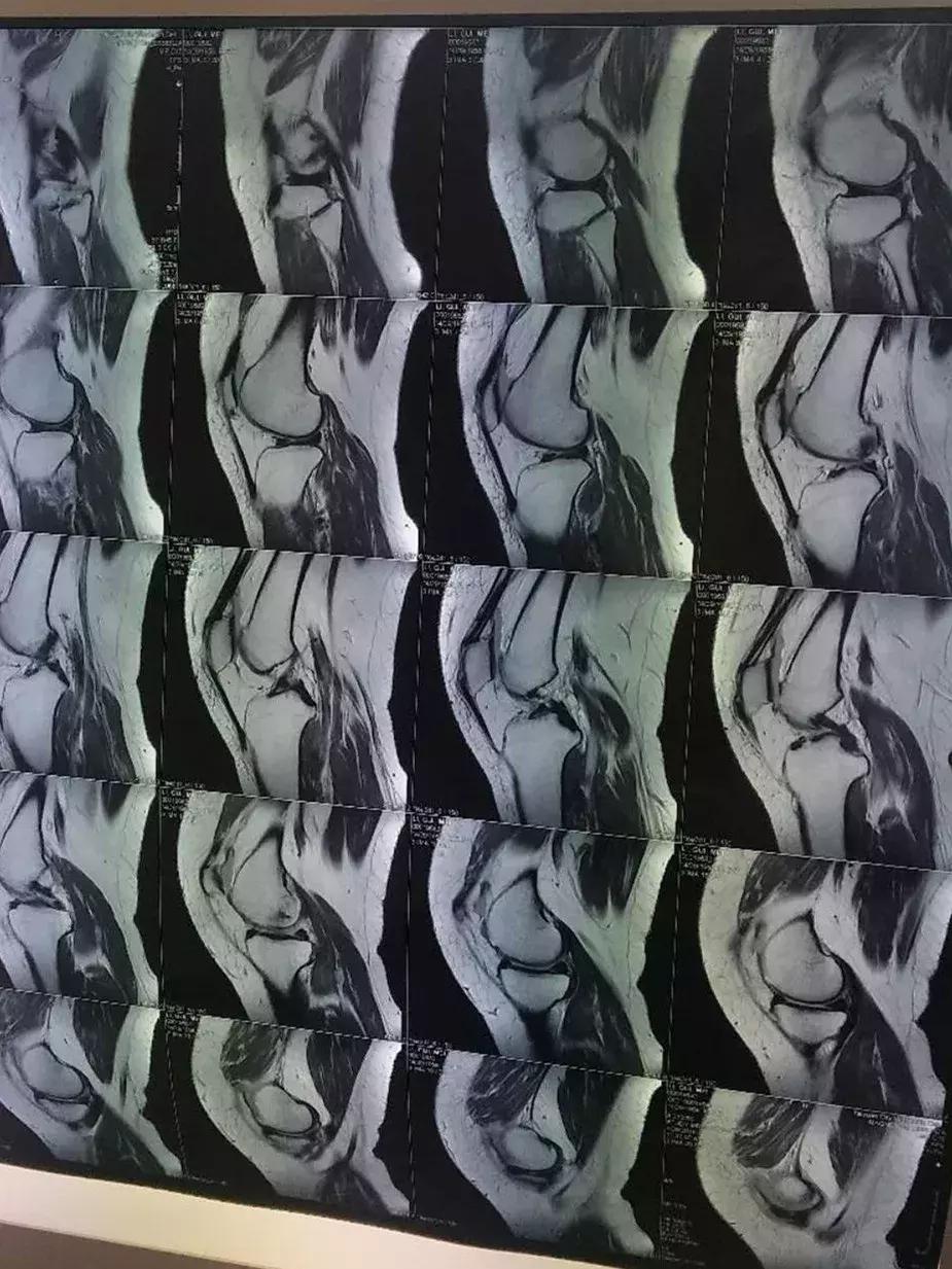 换膝盖关节手术有瘫痪风险吗,换膝手术可以百万医疗理赔吗