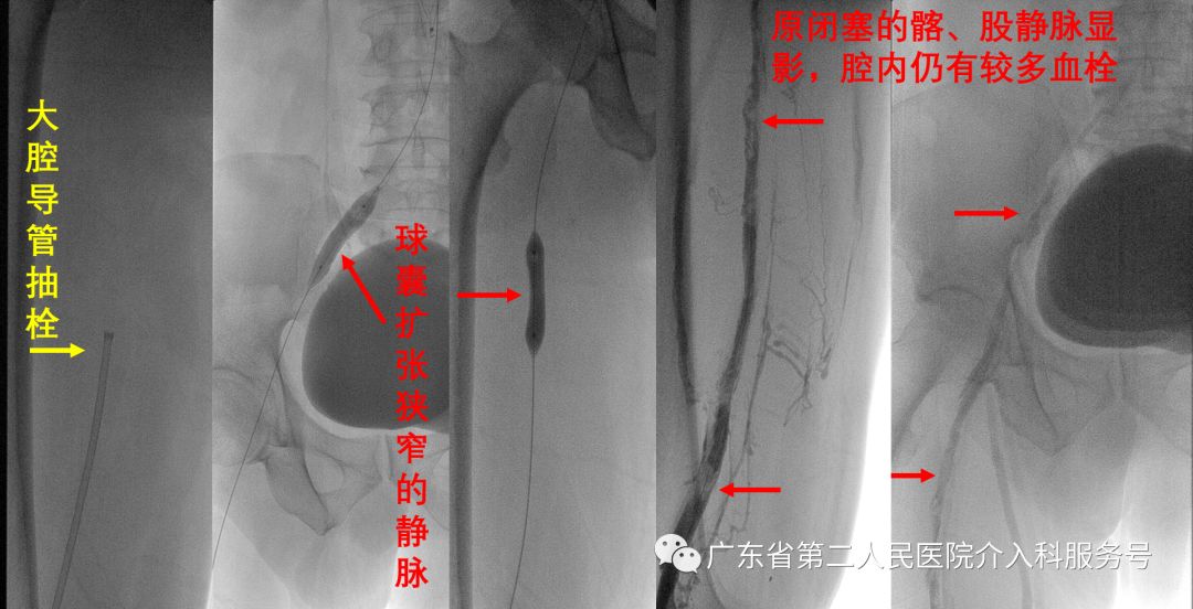 左腿血栓肿胀能完全恢复正常吗,左腿血栓肿痛怎么锻炼
