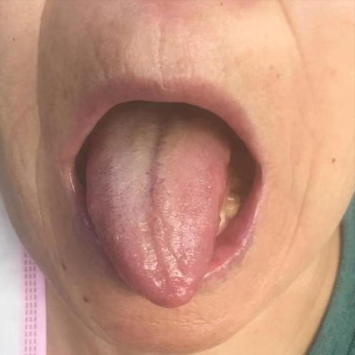 老年人大便秘结的中成药,老年人火旺便秘