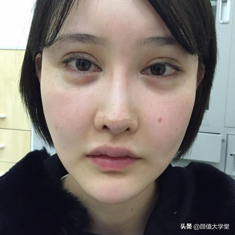 为什么做了双眼皮还不好看,做双眼皮前问清楚自己这三个问题
