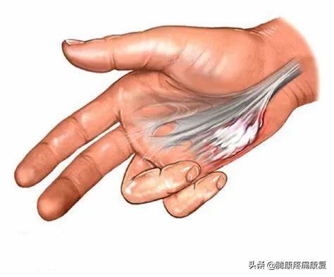 手掌腱膜挛缩不手术会怎样发展,头帽状腱膜挛缩症最新治疗方法